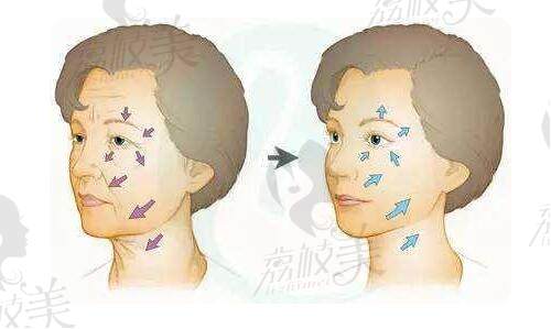 pst面部提升和拉皮的区别