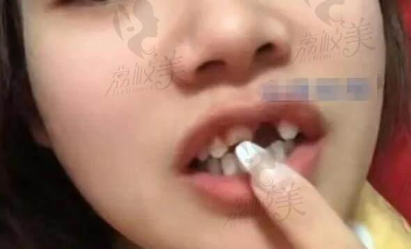 女子阳后一周锻炼晕倒摔断3颗牙