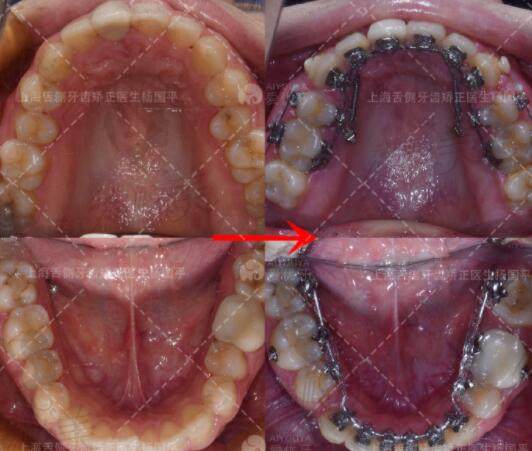 上海杨国平医生正畸实力分享：