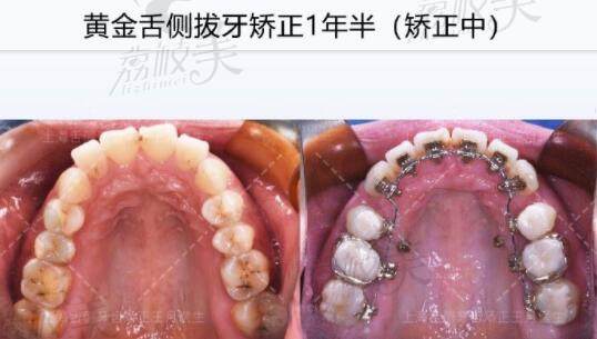 王月医生顾客舌侧拔牙矫正一年后反馈：