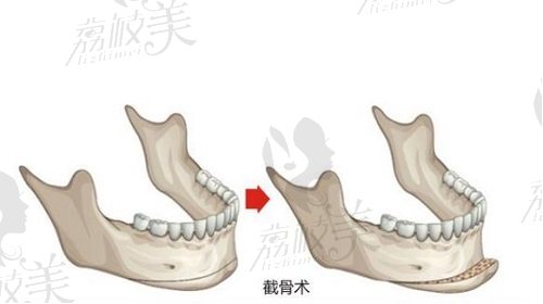 磨骨示意圖