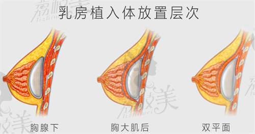 黃廣香隆胸手感怎么樣？