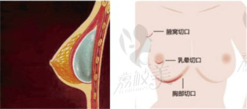 廣州中家醫(yī)黃廣香醫(yī)生豐胸貴嗎？