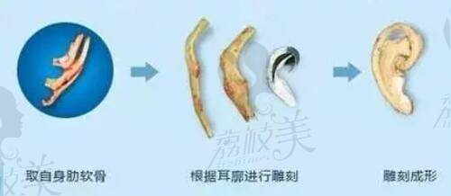 武汉五洲整形外科医院刘嘉锋先天性耳畸形再造手术二期流程