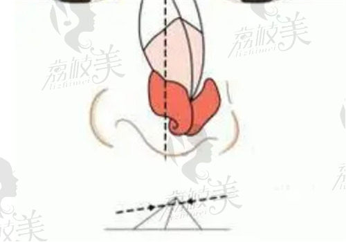 邓东伟医生做高难度隆鼻修复改善歪斜假体的实例