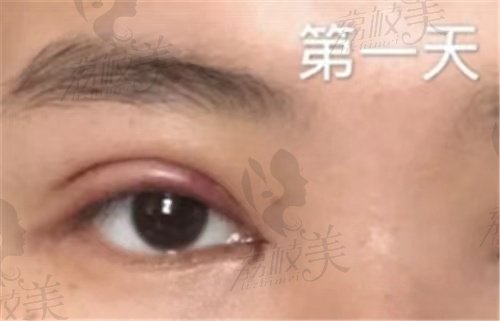 上海美莱吴海龙做双眼皮技术怎么样