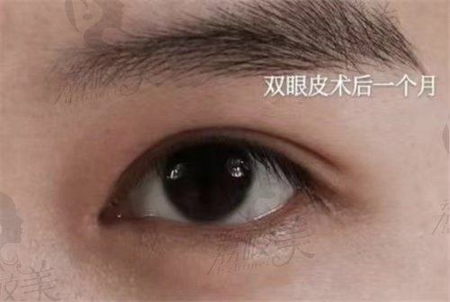 上海吴海龙医生双眼皮整形技术不错
