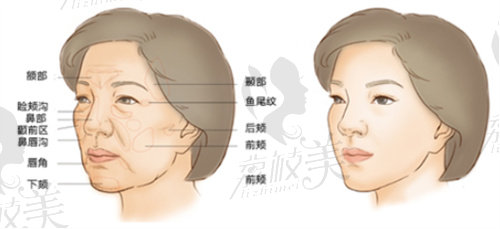 高一生面部填充技术有效改善细纹