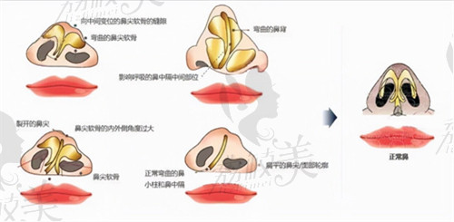 唇裂鼻畸形修復(fù)