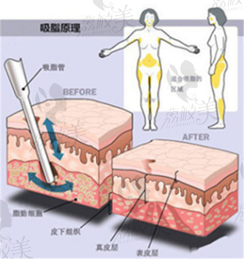 吸脂原理