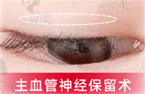 杭州艺星双眼皮主血管神经保留术更好恢复
