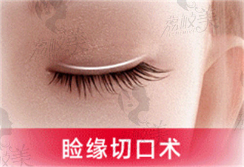 杭州艺星双眼皮睑缘切口术更隐痕