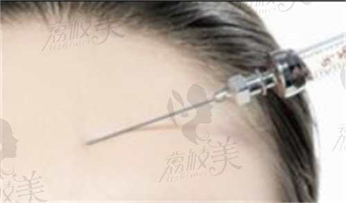 广州广美美雅医疗美容门诊部玻尿酸注射示意图
