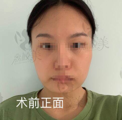 上海薇琳医疗美容医院颌面术前