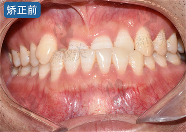 青岛维乐口腔矫正前