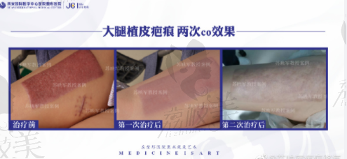 西安国医苏映军治疗增生性疤痕