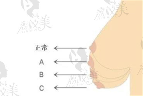 上海伊莱美整形做胸部下垂矫正技术怎么样