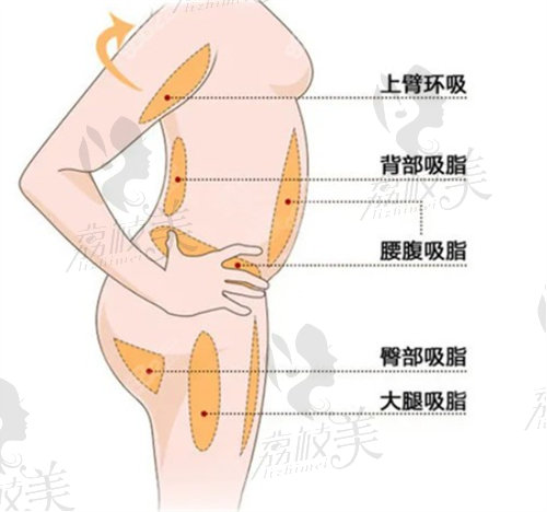 杭州艺星翟爽吸脂价格多少钱？