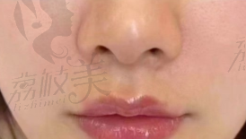 韩国丽菲尔特Lifilltox整形外科鼻基底填充.png