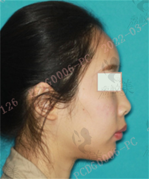 广州紫馨整形正颌手术术后实例
