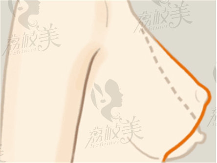 杨大平医生做隆胸修复很擅长，复合隆胸同时改善乳房下垂