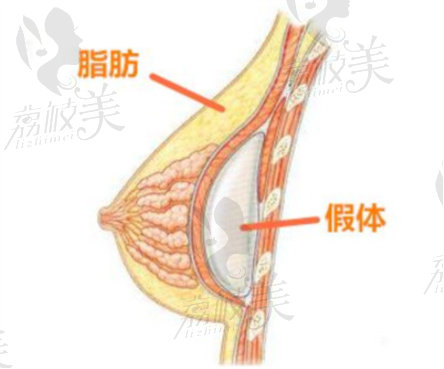 北京杨大平隆胸审美好