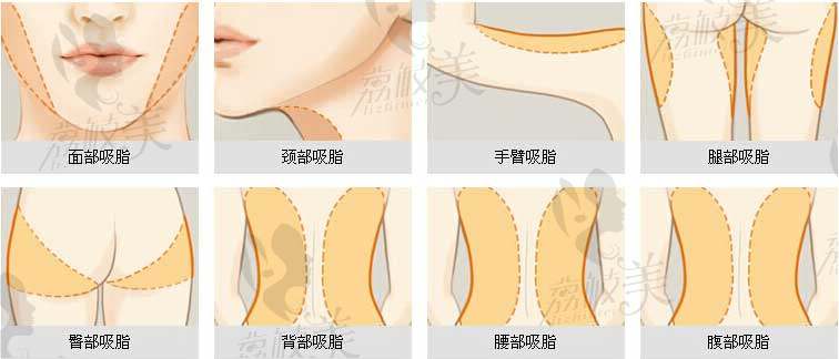 吸脂手术