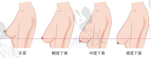 北京乳房缩小哪个医生做的好？