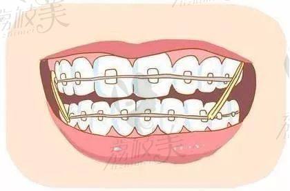 牙齿矫正