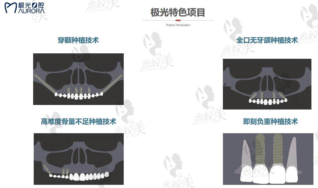 成都极光口腔种植牙特色