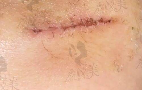 西京医院董立维小耳再造二期手术取肋骨疤痕