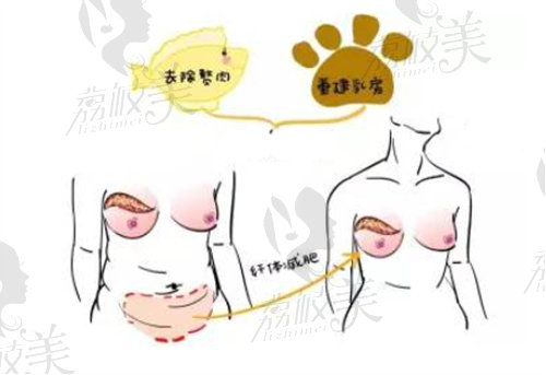 北京美莱做乳房再造手术价格多少钱？