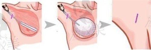 谢卫国医生复合式隆胸手术技术特色