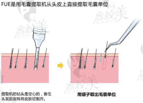 不剃发植发技术