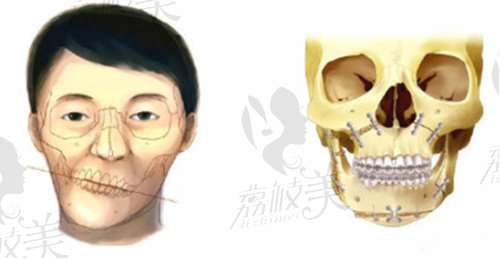 正颌直术和先正畸再正颌区别