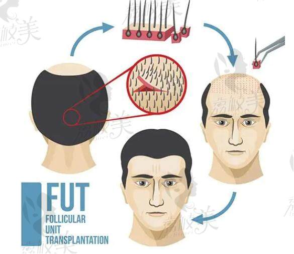 FUT植发技术