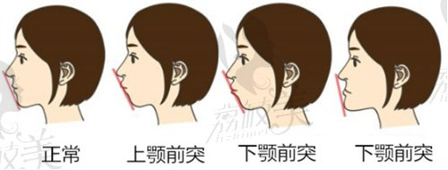 北京联合丽格做正颌手术多少钱？