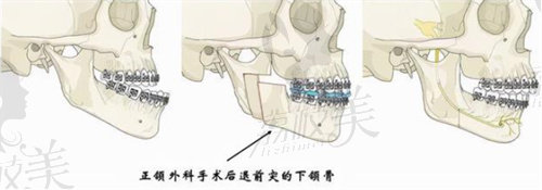 北京联合丽格柳春明医生做正颌直术的特色优势
