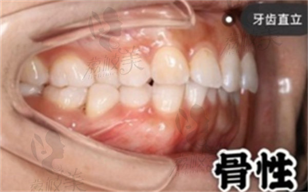骨性牙齿畸形