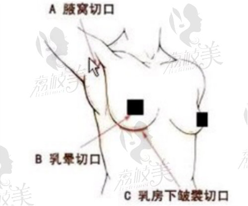 北京李比做隆胸手术多少钱？