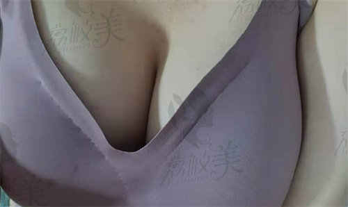 韩国格瑞丝噢爰美整形隆胸术后示意图