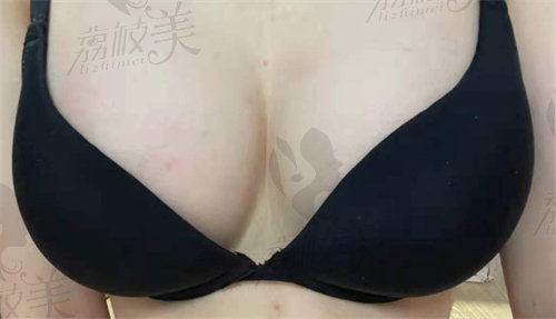 韩国格瑞丝噢爰美整形隆胸术后示意图