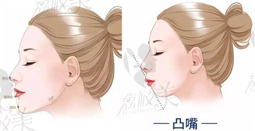 北京八大处整形做正颌手术有什么优势？
