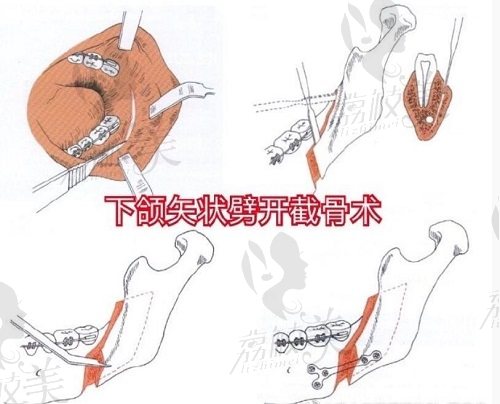 万启龙地包天下颌骨矢状劈开截骨术术式