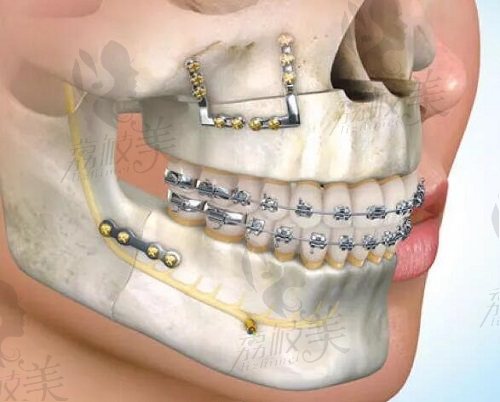 万启龙正颌手术