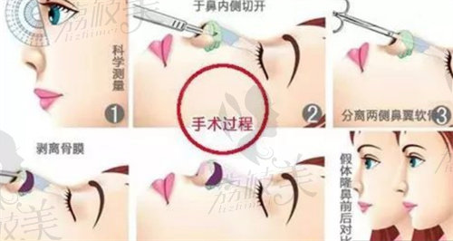 广州紫馨医疗美容医院金孝宪做鼻子的过程