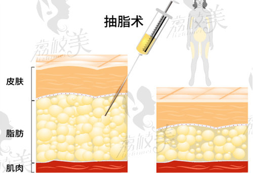 南京美莱整形美容吸脂技术