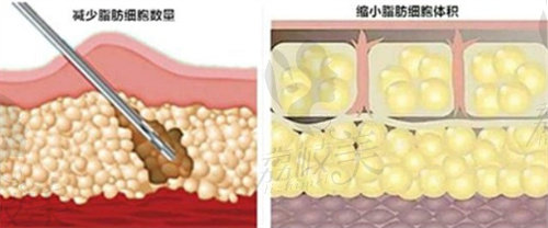 南京美莱整形美容吸脂成效