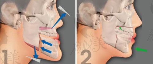 周会喜做地包天正颌手术的方式