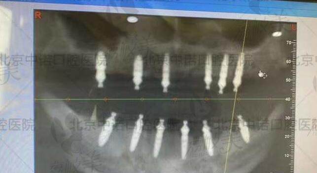 中诺口腔医院全口种植牙片